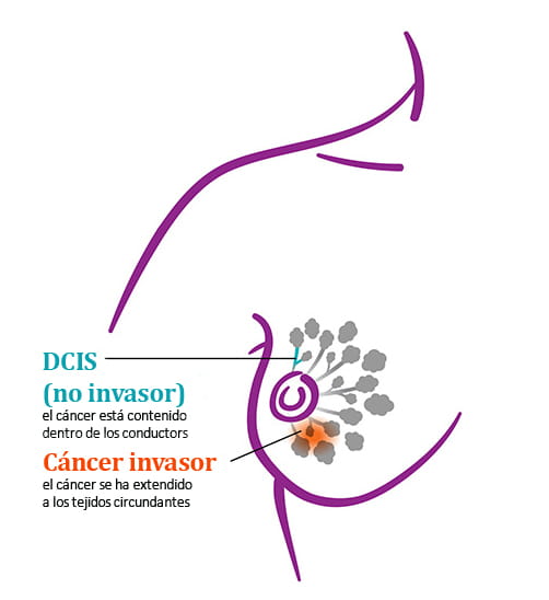 DCIS vs Invasive Breast Cancer US-ES