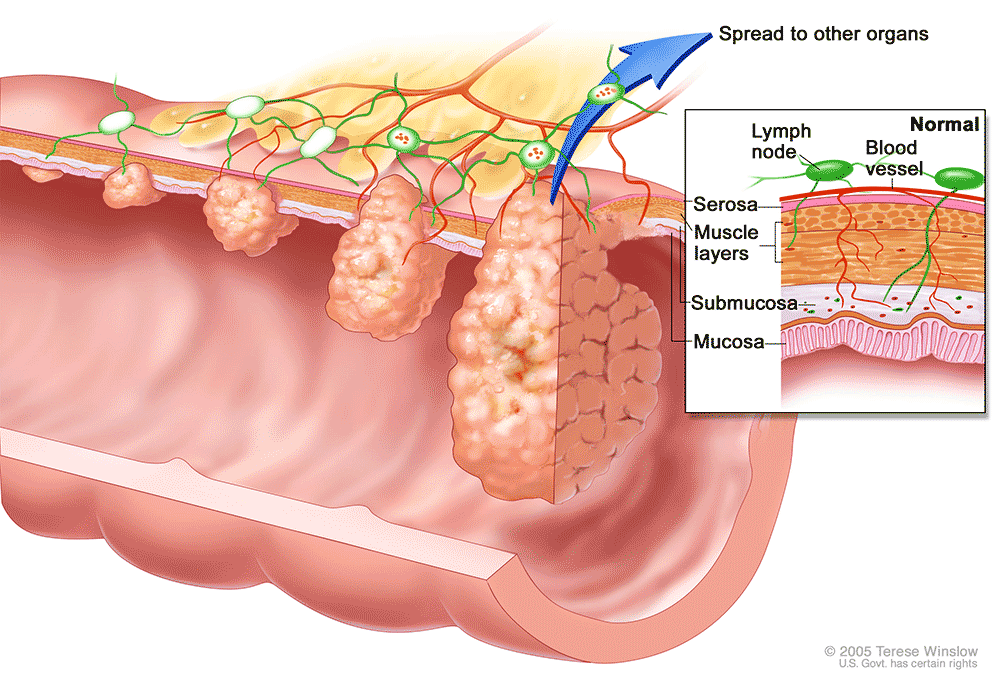 Image of an anatomical split colon with tumor progression"
