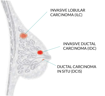 Diagram of breast with red icons of where different types and stages of breast cancer can occur including invasive lobular carcinoma (ILC), invasive ductal carcinoma (IDC) and ductal carcinoma in situ (DCIS)