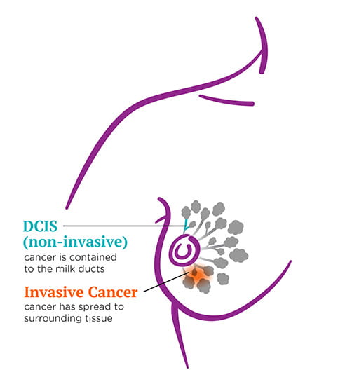 DCIS Invasive breast cancer